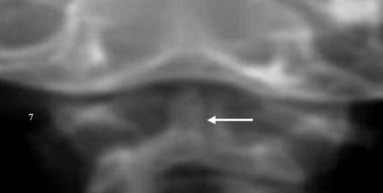 do diastrophic dysplasia patients also have osteopenia or osteoporosis