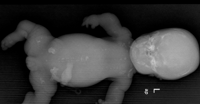 what chromosome is diastrophic dysplasia on