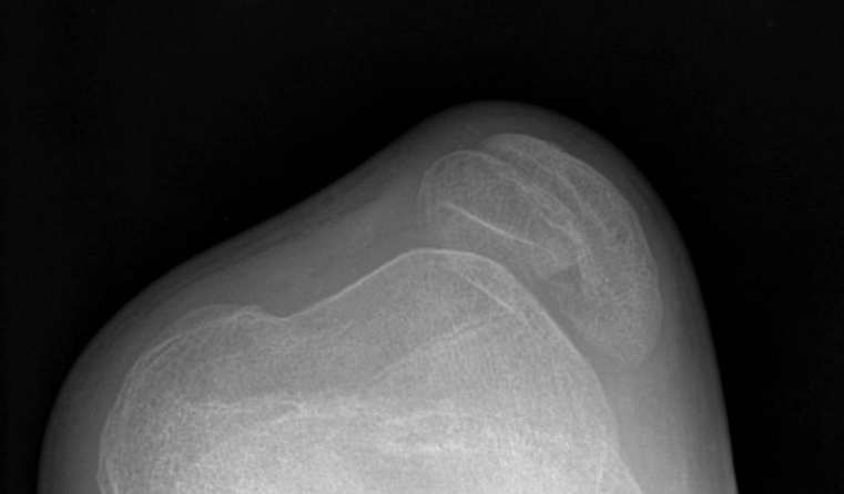 diastrophic dysplasia genereviews