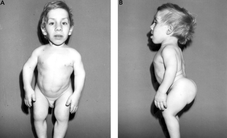 what chromosome is diastrophic dysplasia found on