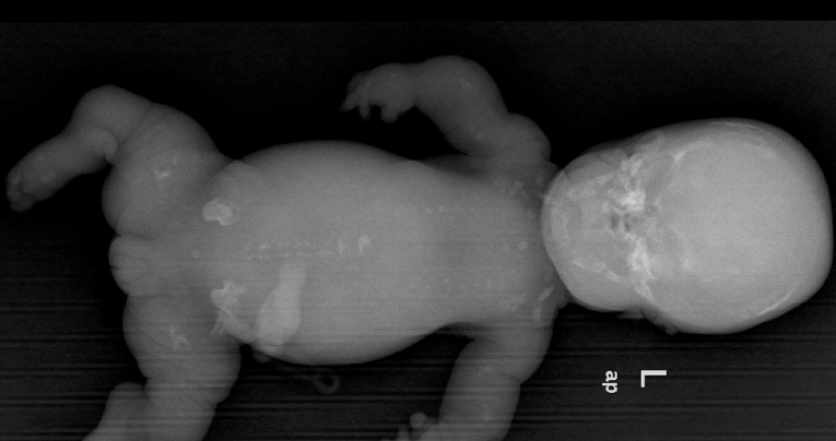 diastrophic dysplasia syndrome symptoms