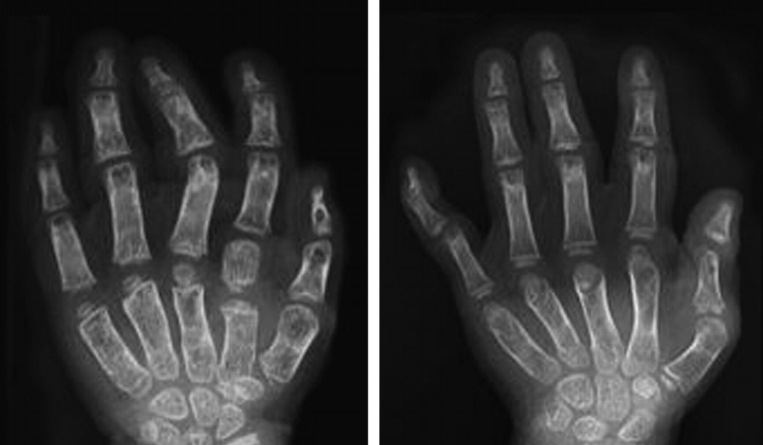 on what dna segment is diastrophic dyplasia found